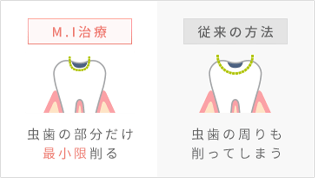 M.I治療 虫歯の部分だけ最小限削る、従来の方法 虫歯の周りも削ってしまう