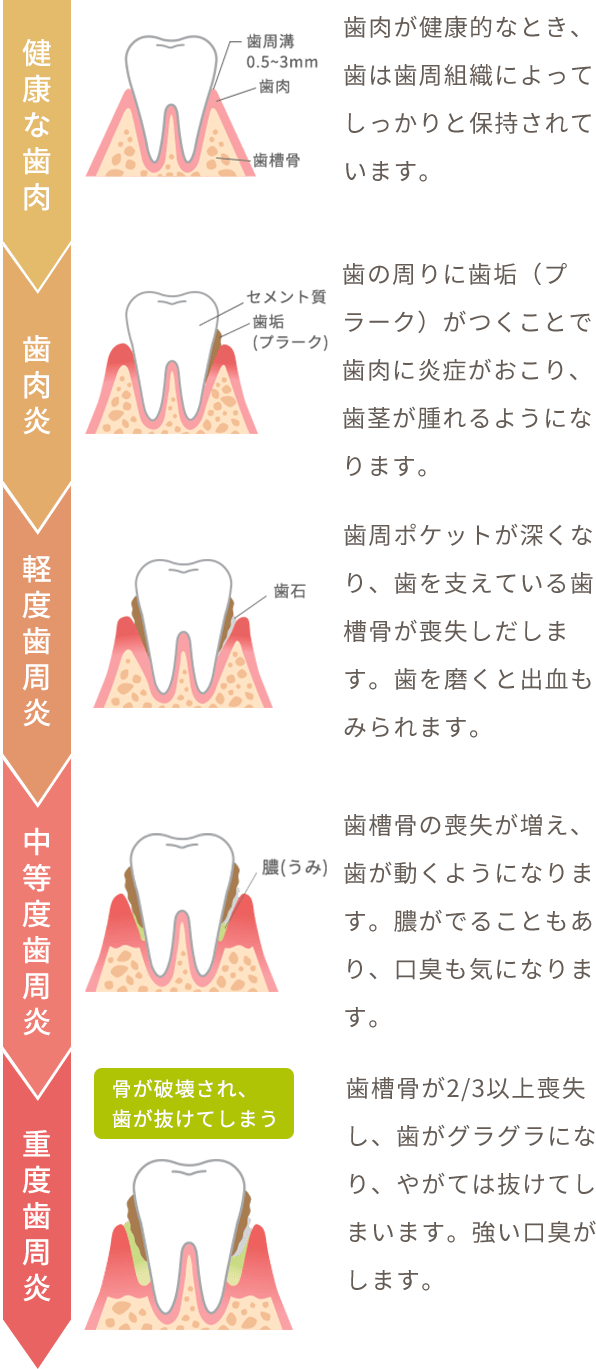 健康な歯肉 歯肉が健康的なとき、歯は歯周組織によってしっかりと保持されています。、歯肉炎 歯の周りに歯垢（プラーク）がつくことで歯肉に炎症がおこり、歯茎が腫れるようになります。、軽度歯周炎 歯周ポケットが深くなり、歯を支えている歯槽骨が喪失しだします。歯を磨くと出血もみられます。、中等度歯周炎 歯槽骨の喪失が増え、歯が動くようになります。膿がでることもあり、口臭も気になります。、重度歯周炎 歯槽骨が2/3以上喪失し、歯がグラグラになり、やがては抜けてしまいます。強い口臭がします。